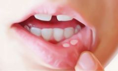 1000 хүүхдэд амны хөндийн үзлэг хийж, шүдний өвчлөлийг үнэ төлбөргүй оношлож байна
