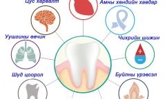 Шүдний өвчлөл хүний эрүүл мэндэд ямар сөрөг нөлөө үзүүлдэг вэ